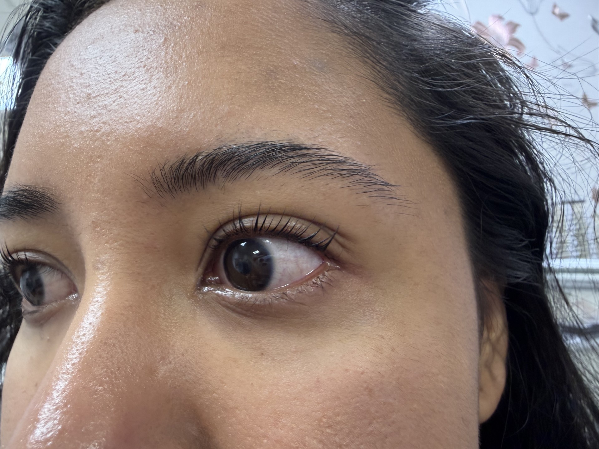 After treatment result