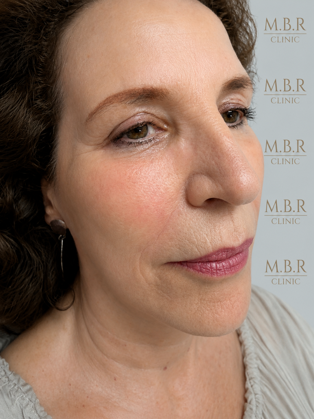 After Face Filler