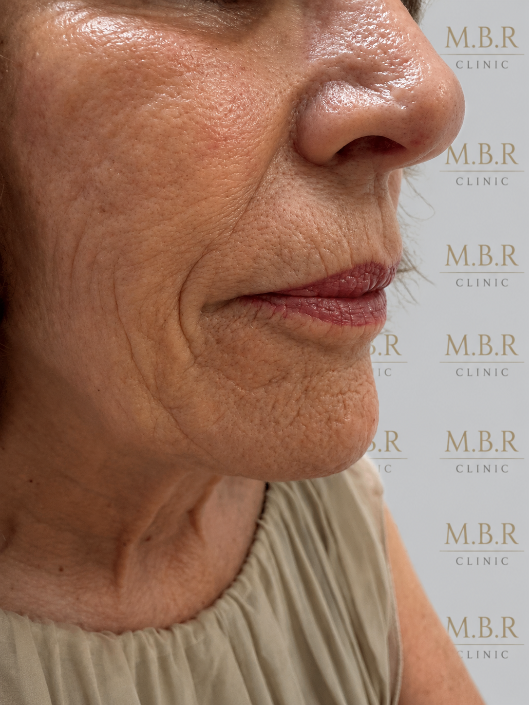 Before Face Filler